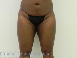 americanlipocenters_153.jpg